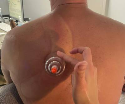 Dry Cupping Treatment-1hr